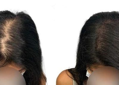 Scalp Micro Pigmentation in Pattaya,Thailand