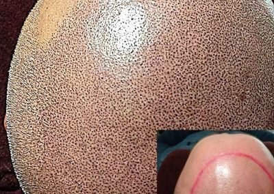 Scalp Micro Pigmentation in Pattaya,Thailand