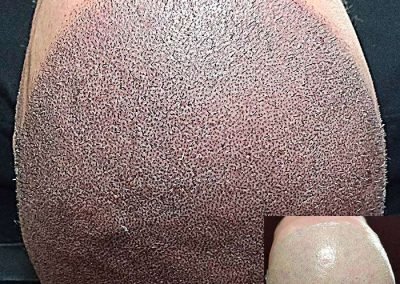 Scalp Micro Pigmentation in Pattaya,Thailand