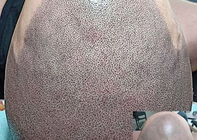 Scalp Micro Pigmentation in Pattaya,Thailand