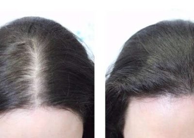 Scalp Micro Pigmentation in Pattaya,Thailand